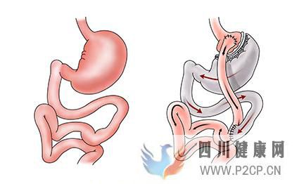 胃旁路手术治疗肥胖型2型糖尿病效果怎么样(图1) 胃旁路手术治疗肥胖型2型糖尿病效果怎么样(图1)