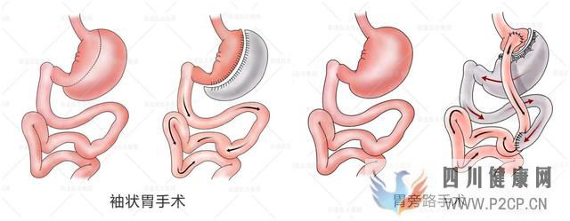 患了2型糖尿病该怎么控制?有没有治疗办法(图3) 患了2型糖尿病该怎么控制?有没有治疗办法(图3)