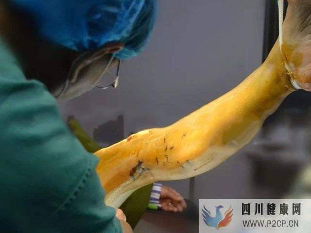 静脉曲张是怎么引起的?静脉曲张的原因无解(图1) 静脉曲张是怎么引起的?静脉曲张的原因无解(图1)