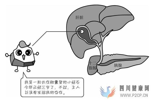 为什么有了胆结石更容易加重糖尿病的病情?这两者有什么联系?(图1) 为什么有了胆结石更容易加重糖尿病的病情?这两者有什么联系?(图1)