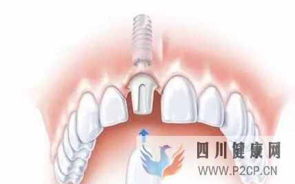 廊坊人必知的口腔知识|做种植牙的七大好处(图1) 廊坊人必知的口腔知识|做种植牙的七大好处(图1)