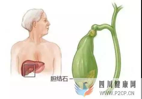 对于患有胆结石的人来说,有些东西是千万不能吃的,会加重病情(图1) 对于患有胆结石的人来说,有些东西是千万不能吃的,会加重病情(图1)