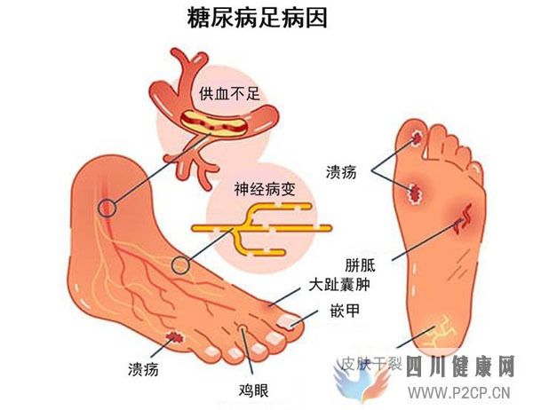 研究证实间充质干细胞治疗糖尿病足有益!伤口完全闭合率达82%(图1) 研究证实间充质干细胞治疗糖尿病足有益!伤口完全闭合率达82%(图1)