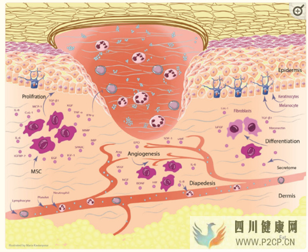 研究证实间充质干细胞治疗糖尿病足有益!伤口完全闭合率达82%(图3) 研究证实间充质干细胞治疗糖尿病足有益!伤口完全闭合率达82%(图3)