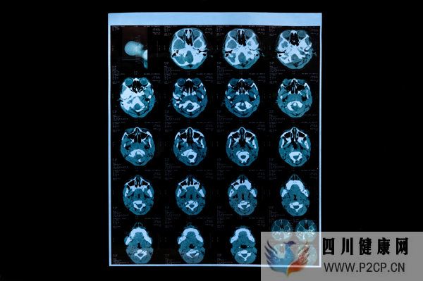 呼吸道病毒感染潮蔓延背后,CT正在被滥用?(图3) 呼吸道病毒感染潮蔓延背后,CT正在被滥用?(图3)